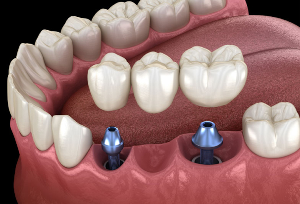 dental implant bridge