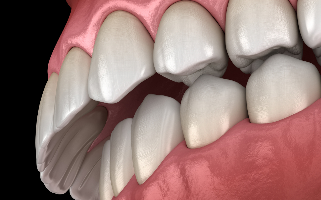 overbite 3d render