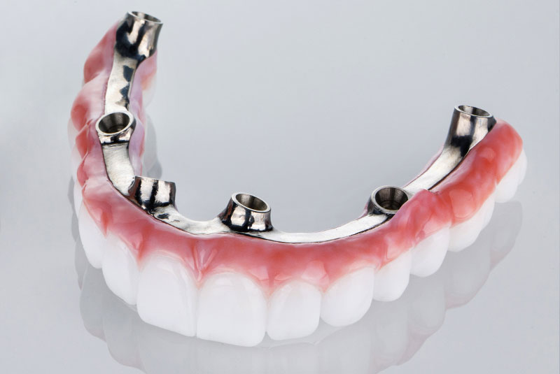 zirconia upper bridge model light background